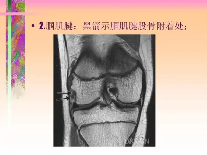 膝关节mri之正常解剖(外文综述)ppt