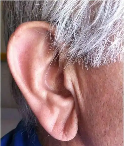 这个耳朵上的小细节能看出你有无冠心病