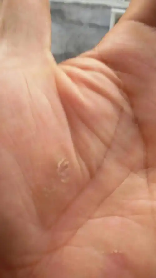 手掌心旁有个茧一样的东西,平时还有点痒,是手癣吗?