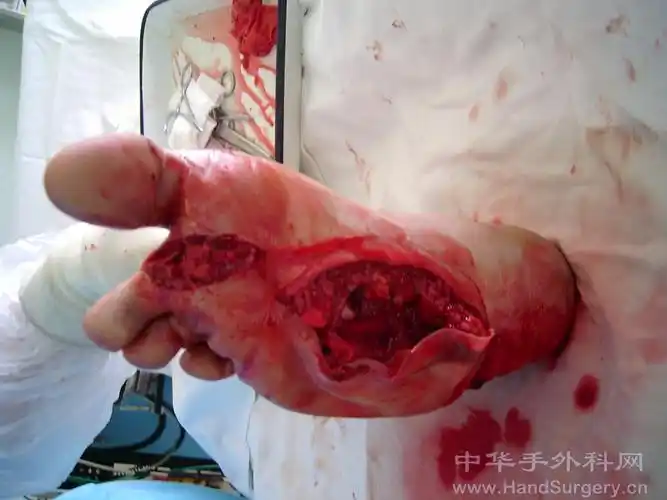 重物压砸伤,多处粉碎性骨折最佳处理方法是什么?