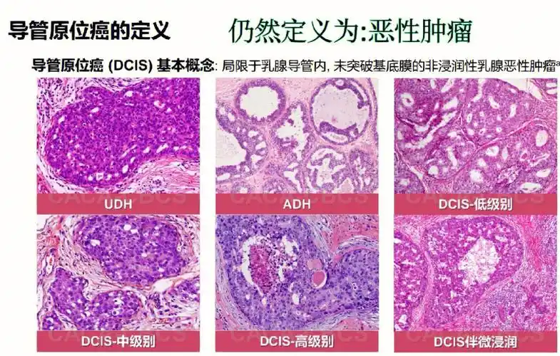 关于原位癌放疗的问题之前有问到这里专门讲一讲乳腺原位癌有分两种