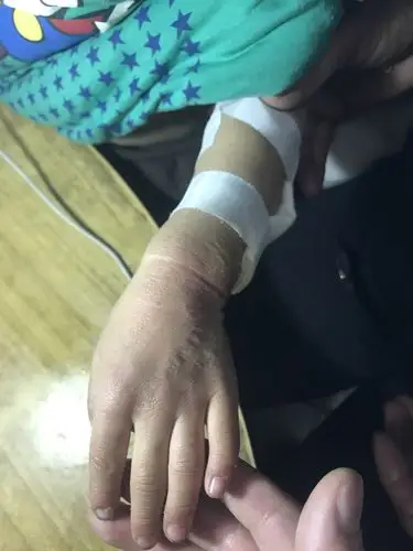 502强力胶水粘住宝宝的小手,如何急救?