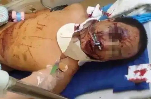 心疼!九江男子为了给女儿筹学费,连续熬夜劳作,遭车祸肠子被戳穿!