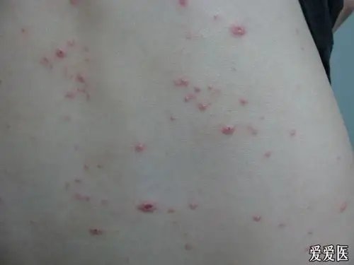 小护士值班后出现皮疹---成人水痘
