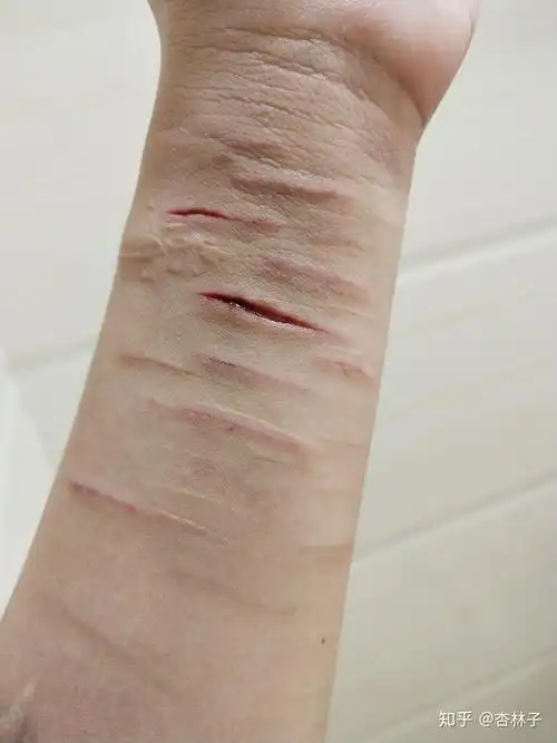 自残属于什么心理