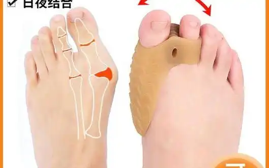【优惠券】脚趾矫正器可以穿鞋大脚骨拇指外翻矫正器男女士大脚趾重叠