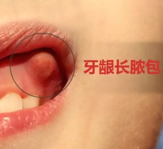 牙龈上长了个脓包,可以自己刺破吗?