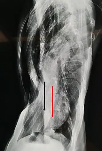 图4,脊柱侧弯,心脏位于左侧胸腔.
