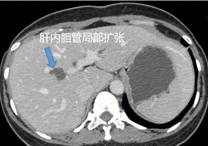 医学影像学  #临床  #医学肝内胆管局限性扩张,远端未见扩张,胰头部