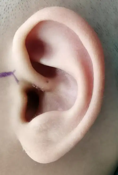 罕见双瘘口耳前瘘管一例 - 好大夫在线