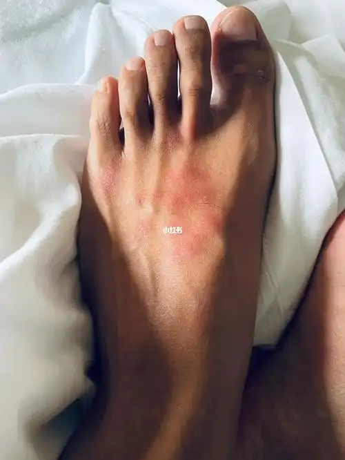 被海蜇咬后的第二天