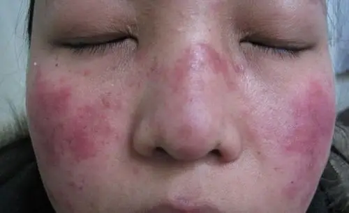 系统性红斑狼疮女性能否怀孕医生时机很关键