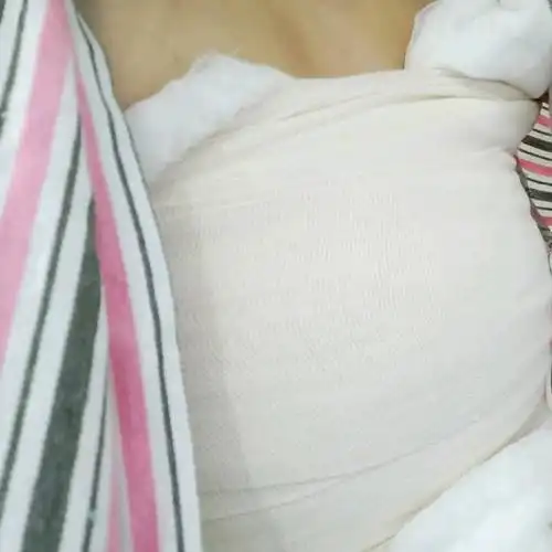 乳房提升手术今天是第二天,手术过后都是要这样包扎的_圈子-新氧美容