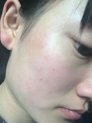 脸上不知道为什么一片红红的 同一个地方复发两次 摸起来很干 过一