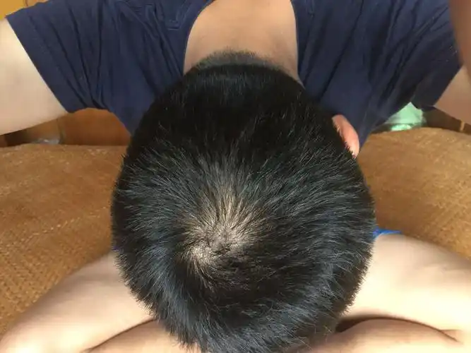 我这头发漩涡处算不算少23岁