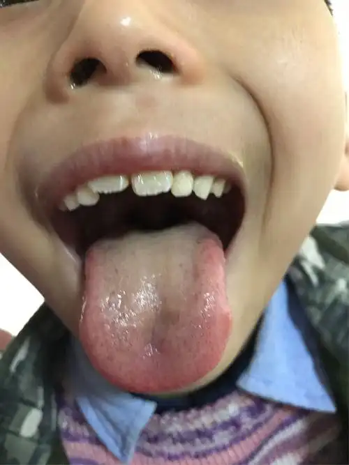 舌苔厚腻,脾胃湿热症,患儿唇白而干,形体消瘦,身体抵抗力极差,常外感