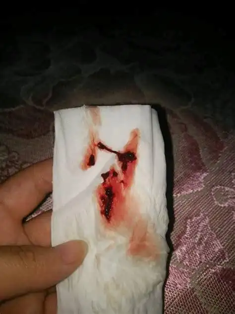 如果怀孕后出现出血的现象那就是先兆流产,和平时的月经是有区别的,比