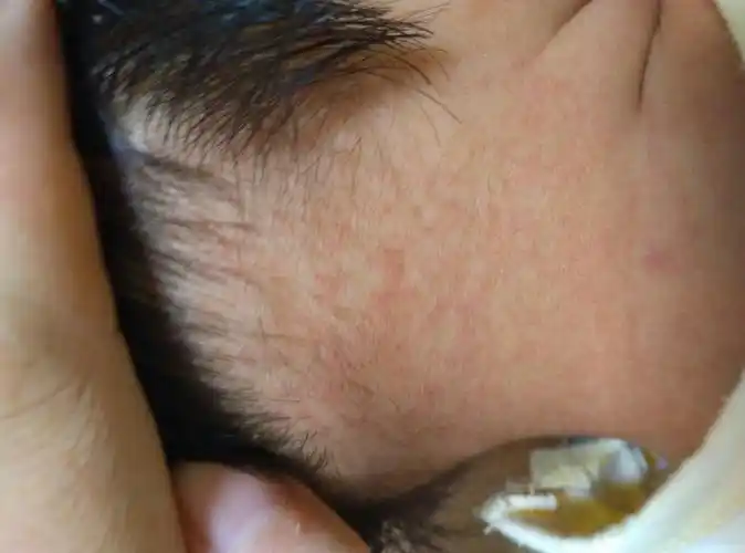 宝宝热出痱子,到底该不该开空调?婴儿夏日舒适指南,误区别再踩