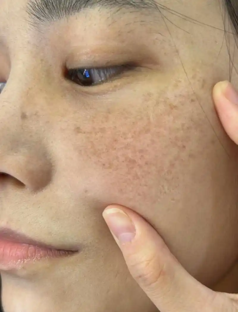 色素斑,是肌肤上的一种常见问题,给人们带来了不少困扰.它们的出现让