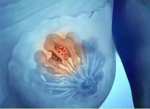 【abus乳腺超声公益筛查,关爱乳房远离乳腺癌】-杭州玛莉亚医院