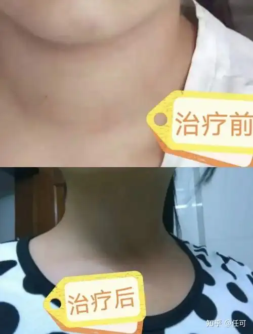 女性群体最受甲减青睐谨防被宠幸