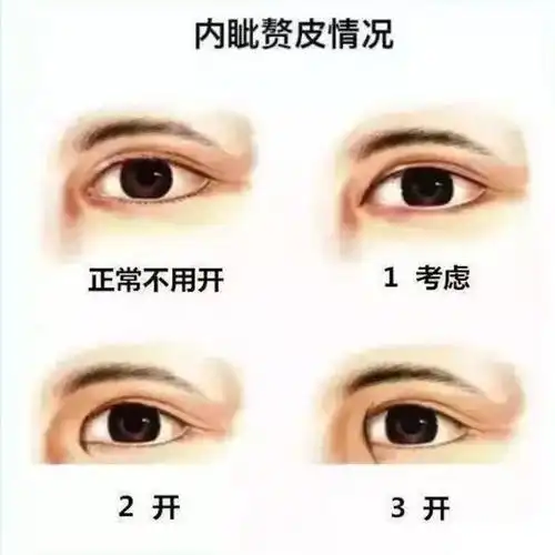 非常严重的内眦赘皮怎么办