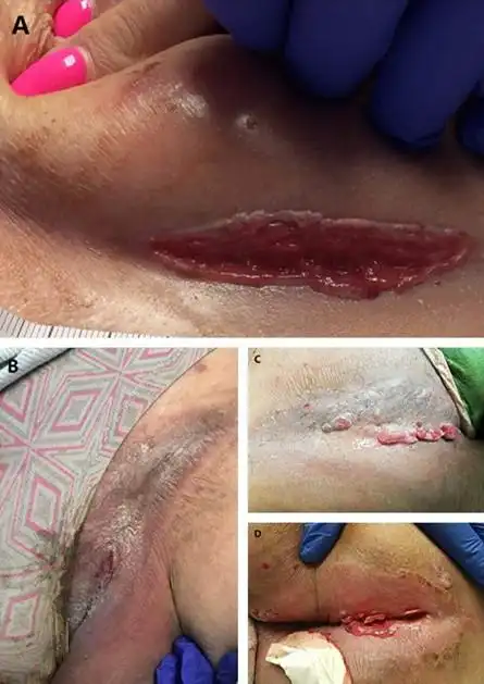 病例学习_便血_皮肤溃疡_医脉通