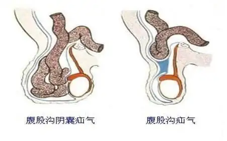 4496 | 回复: 3 宝来论坛 疝气的症状图片 男人疝气的症状表现 1,在