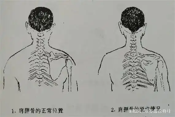 出现明显肩胛骨突出,可能是脊柱侧弯|手术|治疗|畸形|症状_网易订阅