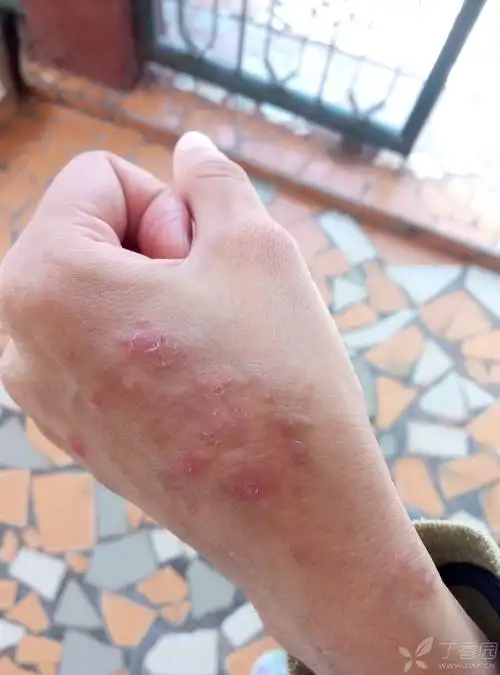 手上长的疹子,不知道是那种皮肤病麻烦大家帮忙诊断一下,给些建议