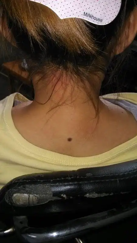 我爱人脖劲背后有黑痣,吉?凶?还有什么?