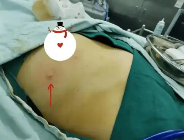 济南中科甲乳医院乳腺名医李维亚以针代刀巧除乳腺结节不留疤