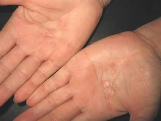 男性一期梅毒图片37