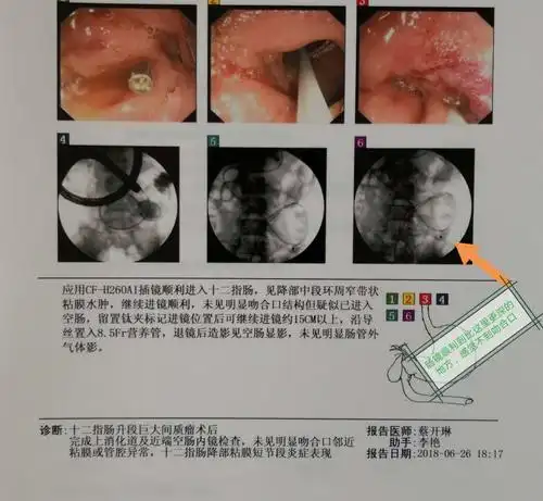 日常工作中的十二指肠肿瘤实例