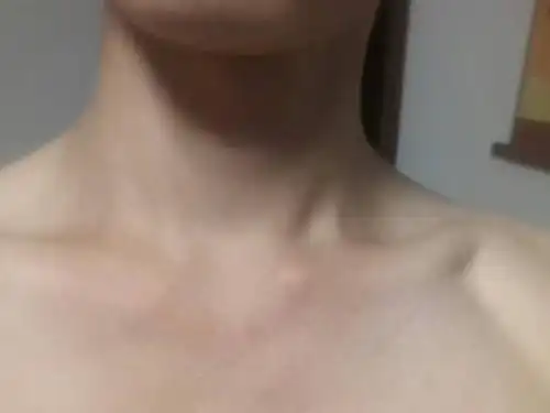 我的左臂锁骨最靠近脖子那个末端骨头突出了出来.很硬,没有痛觉.