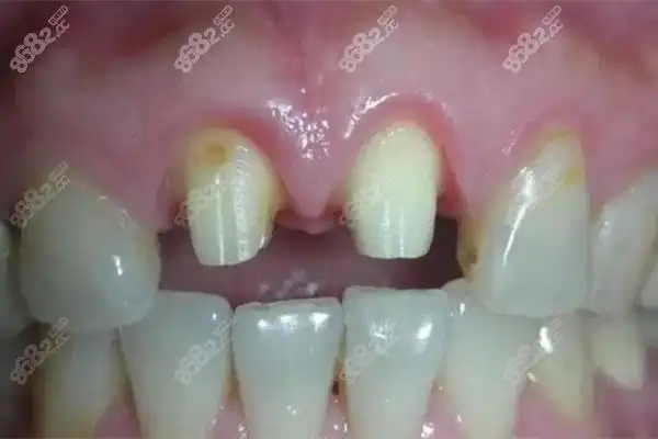 经过咨询之后,医生给出的方案是:牙齿磨小之后不想做烤瓷冠