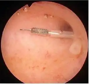 【病例分享】她数次胎停,宫腔粘连 .