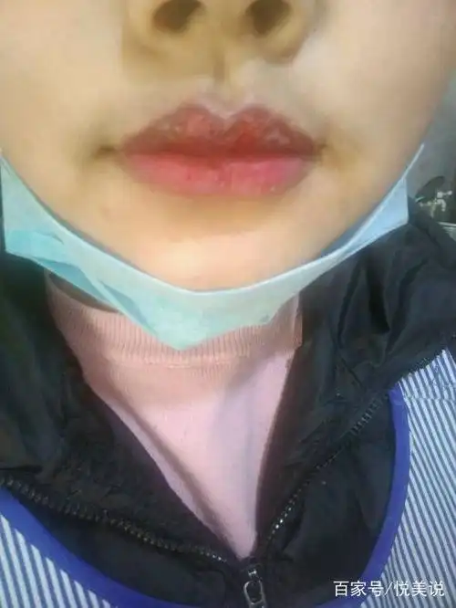做"纹唇"后闺蜜说:乌唇终于没了,红唇 白脸蛋让你很妖艳