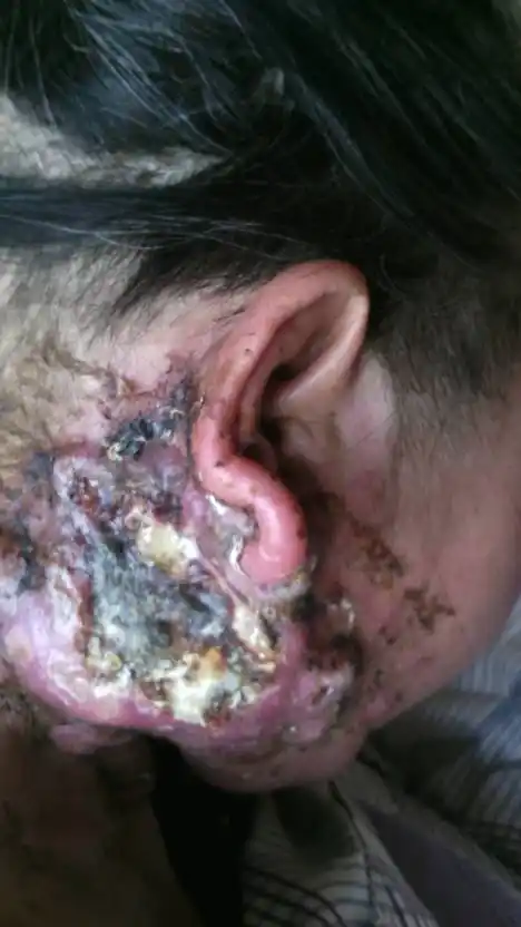 淋巴癌还是淋巴结核?