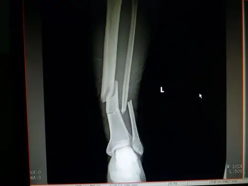 三例胫腓骨远端骨折