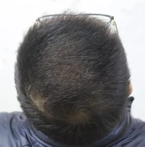 秃顶植发3个月了,目前头顶头发还是有些稀疏