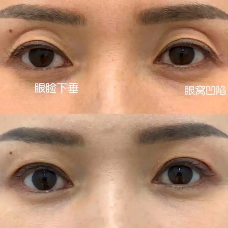 眼窝凹陷怎么恢复饱满?