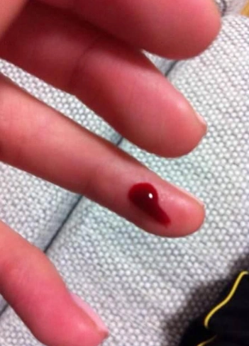 手出血的图片61