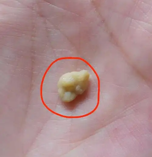 扁桃体结石|不规则的小颗粒,非常臭,还忍不住想闻?本文说清楚