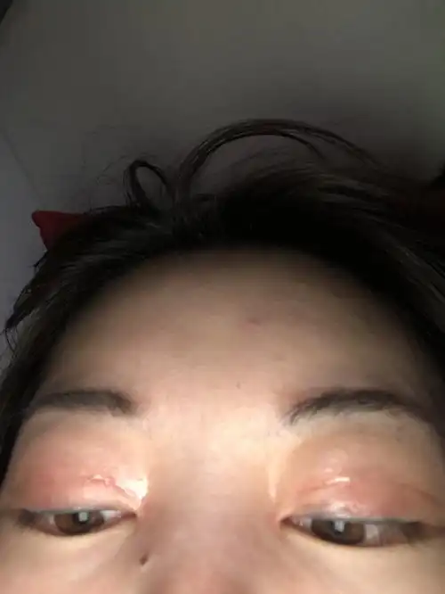 双眼皮开内眼角2个月,内眼角有点疤痕增生自己担心能不能消掉