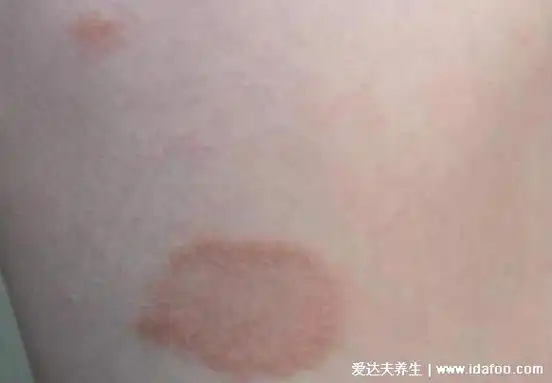 100种皮肤病对照表,各种皮肤病对照图片大全及症状 — 爱达夫养生