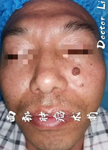 面部恶性肿瘤修复_基底细胞癌_基底细胞癌治疗方式 - 好大夫在线