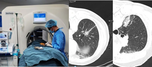 重庆首例机器人导航ct经皮肺结节射频消融术完成