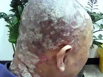 成都银康银屑病医院_成都牛皮癣医院_成都治疗银屑病的医院