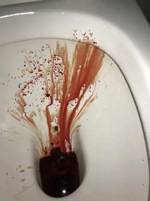 大便出血严重怎么回事?